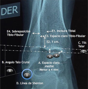 Dr. Juan Manuel Herrera - Research on ankle fractures